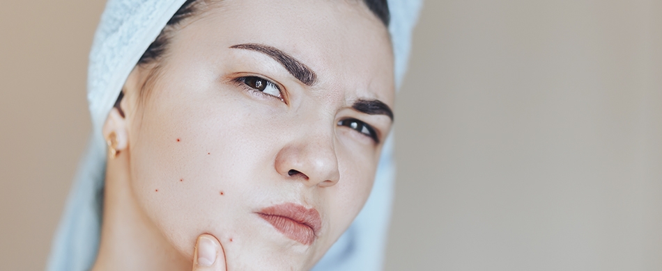 Lidando com acne durante a fase adulta