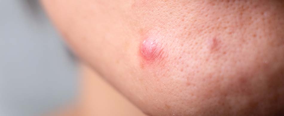 Saiba mais sobre a acne