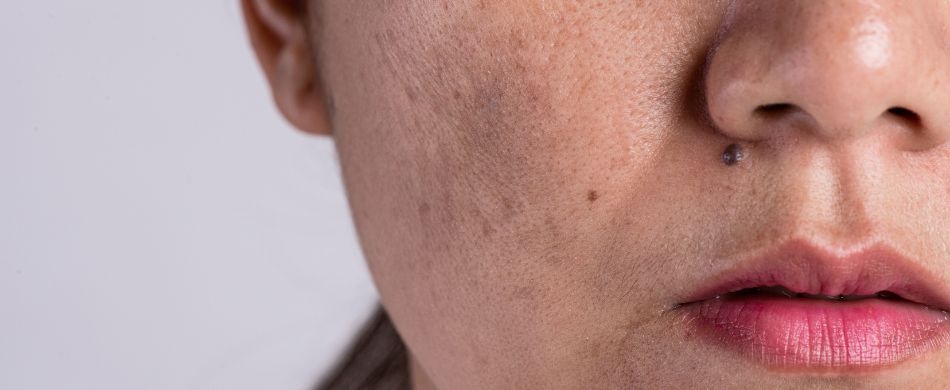 Cuidados com o Melasma no verão