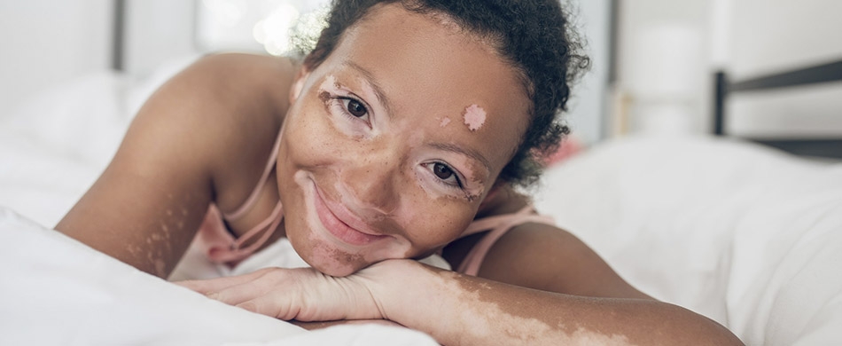 O que é o Vitiligo?